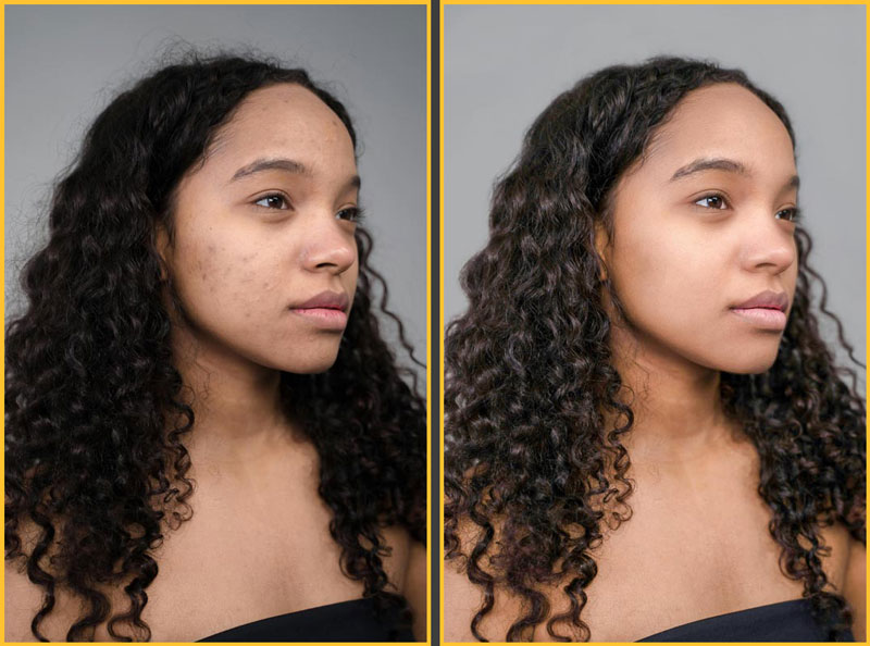 Beautiful woman before and after showing removal of skin issues.